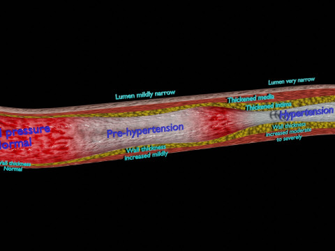 Hypertension blood vessel artery structural change 3D-Modell