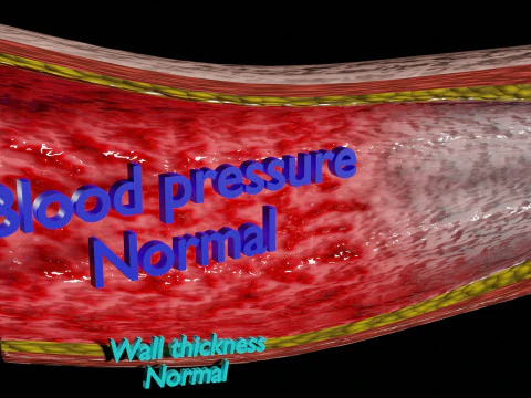 Hypertension blood vessel artery structural change 3D Model
