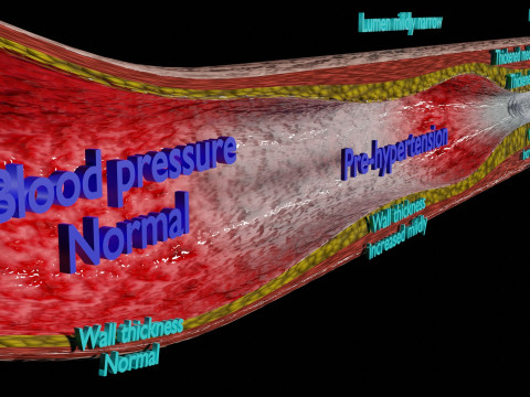 Hypertension blood vessel artery structural change 3D-Modell