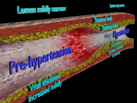 Hypertension blood vessel artery structural change 3D-Modell
