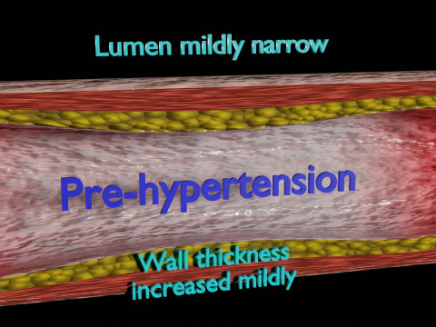 Hypertension blood vessel artery structural change 3D-Modell