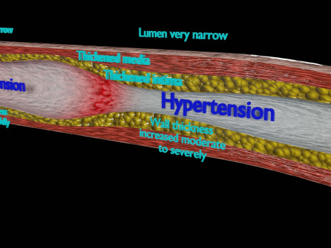 Hypertension blood vessel artery structural change 3D-Modell