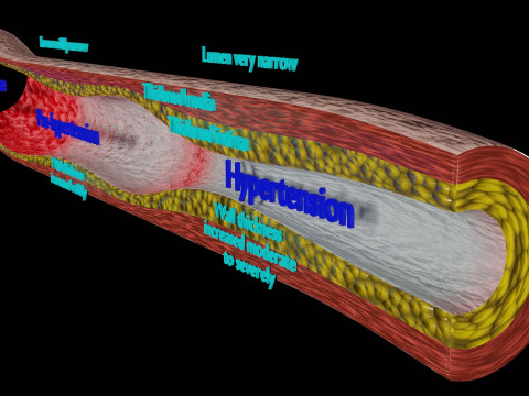 Hypertension blood vessel artery structural change 3D-Modell