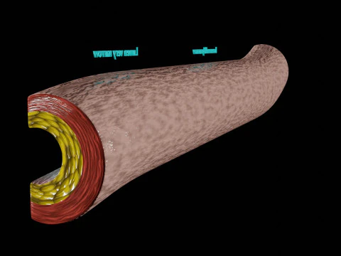 Hypertension blood vessel artery structural change 3D Model
