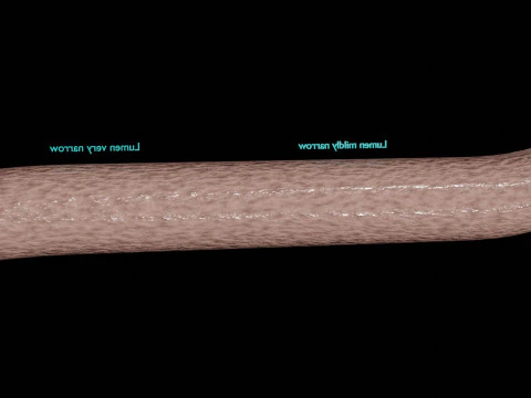 Hypertension blood vessel artery structural change 3D Model