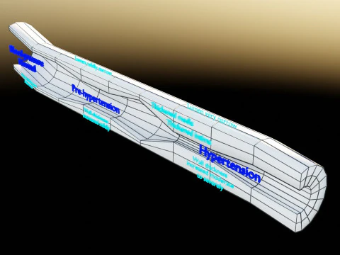 Hypertension blood vessel artery structural change 3D Model
