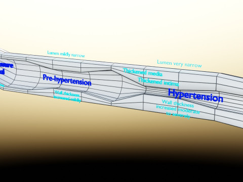 Hypertension blood vessel artery structural change 3D-Modell