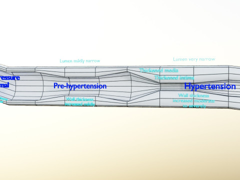 Hypertension blood vessel artery structural change 3D-Modell