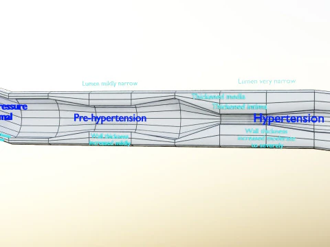 Hypertension blood vessel artery structural change 3D Model