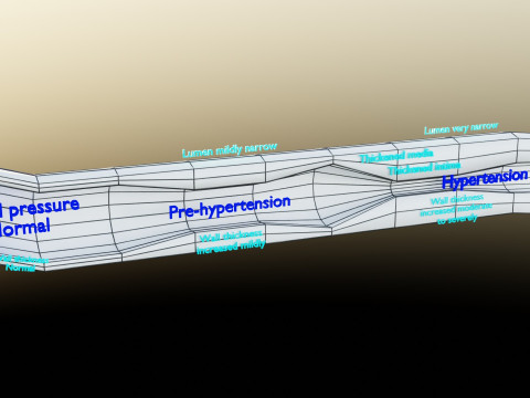 Hypertension blood vessel artery structural change 3D-Modell
