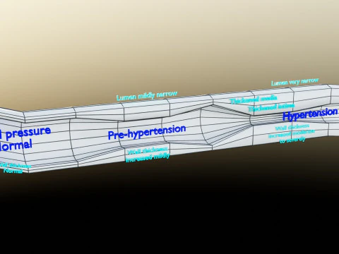 Hypertension blood vessel artery structural change 3D Model