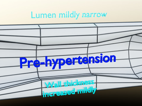 Hypertension blood vessel artery structural change 3D-Modell