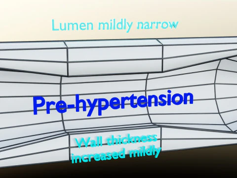 Hypertension blood vessel artery structural change 3D Model