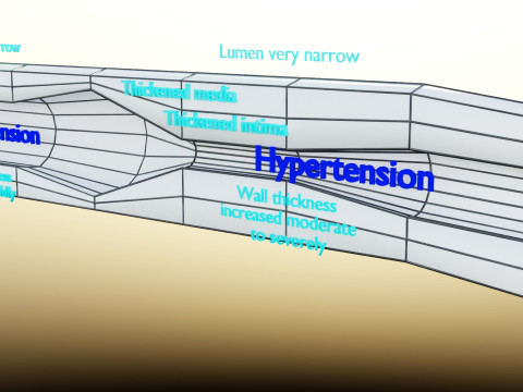 Hypertension blood vessel artery structural change 3D-Modell