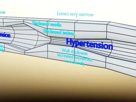 Hypertension blood vessel artery structural change 3D Model
