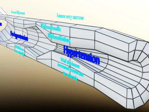 Hypertension blood vessel artery structural change 3D Model