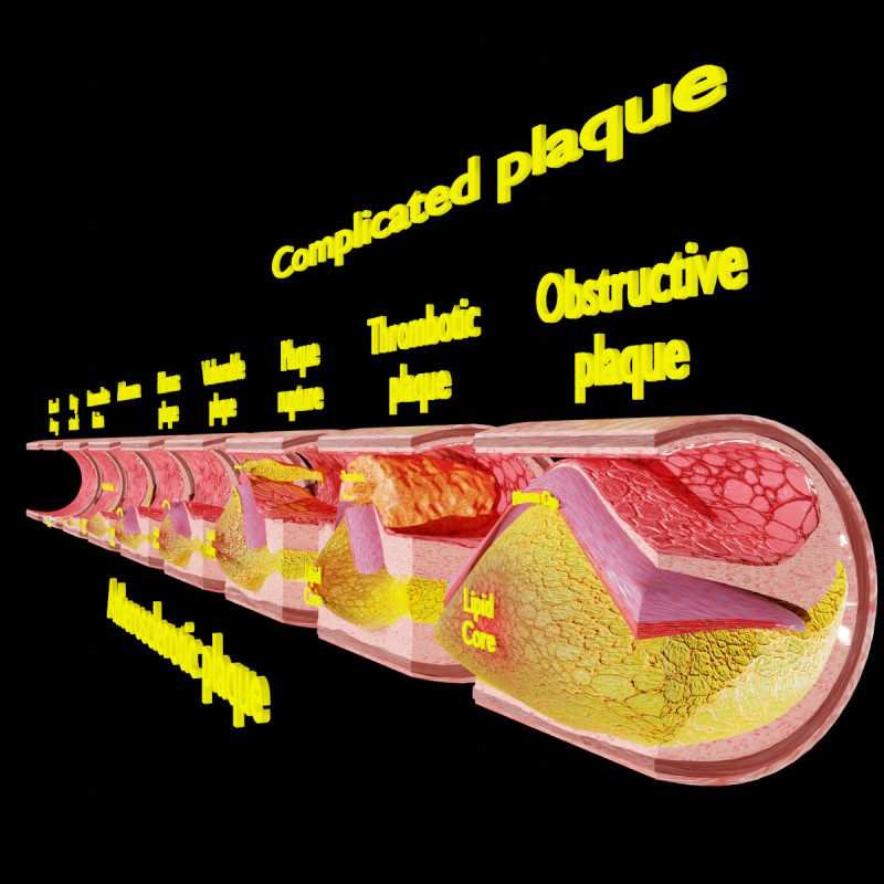 Artery Atherosclerosis plaque and consequences 3D Model .c4d .max .obj .3ds .fbx .stl .blend 