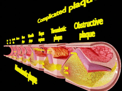 Placa de aterosclerose arterial e consequ&ecirc;ncias Modelo 3D