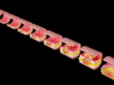 Artery Atherosclerosis plaque and consequences 3D Model