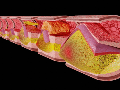 Artery Atherosclerosis plaque and consequences 3D Model