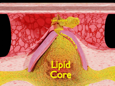 Artery Atherosclerosis plaque and consequences 3D Model