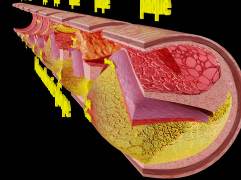 Artery Atherosclerosis plaque and consequences 3D Model