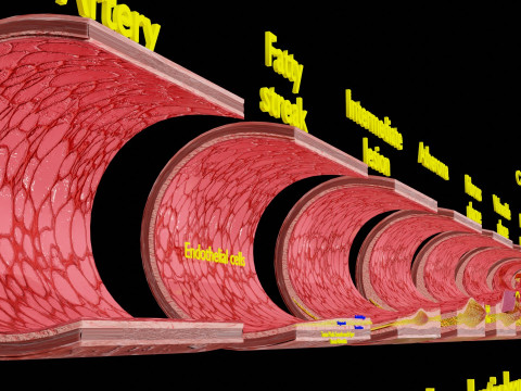 Artery Atherosclerosis plaque and consequences 3D Model