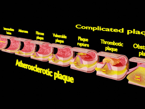 Artery Atherosclerosis plaque and consequences 3D Model