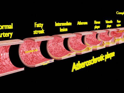 Artery Atherosclerosis plaque and consequences 3D Model