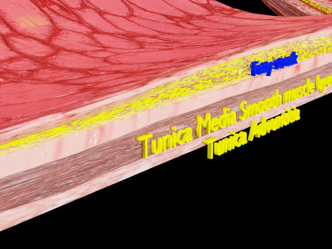 Artery Atherosclerosis plaque and consequences 3D Model