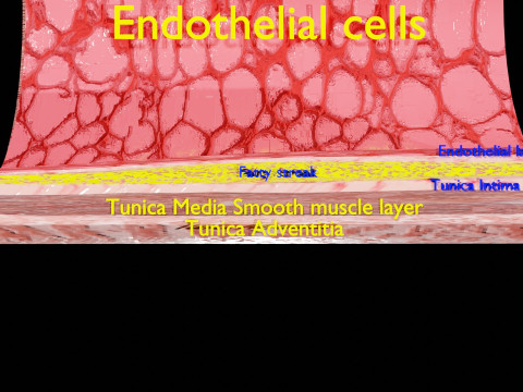 Artery Atherosclerosis plaque and consequences 3D Model