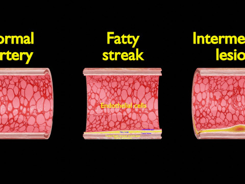 Artery Atherosclerosis plaque and consequences 3D Model