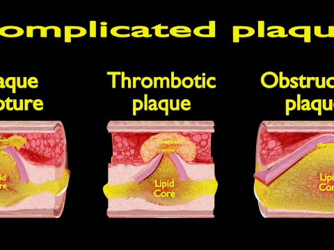 Artery Atherosclerosis plaque and consequences 3D Model
