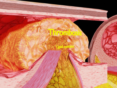 Artery Atherosclerosis plaque and consequences 3D Model