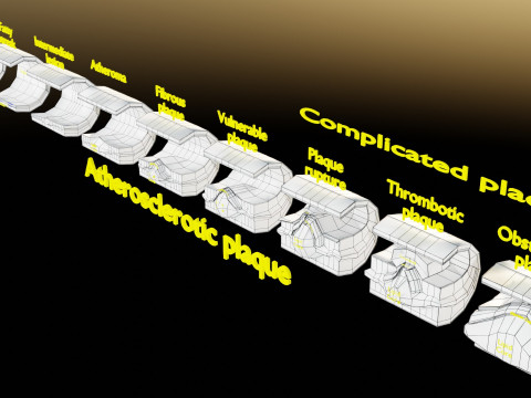 Artery Atherosclerosis plaque and consequences 3D Model