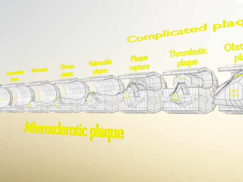 Artery Atherosclerosis plaque and consequences 3D Model