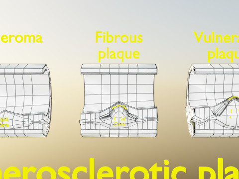 Artery Atherosclerosis plaque and consequences 3D Model