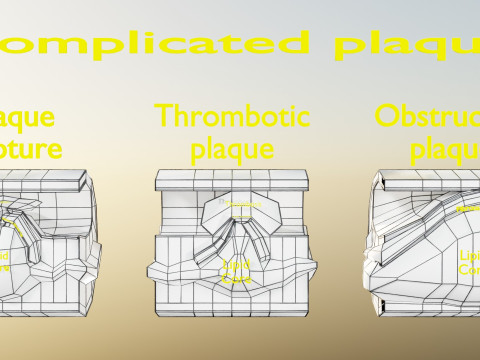 Artery Atherosclerosis plaque and consequences 3D Model