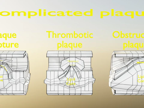 Artery Atherosclerosis plaque and consequences 3D Model