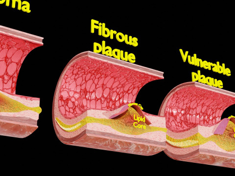 Artery Atherosclerosis plaque and consequences 3D Model