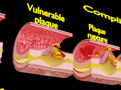 Artery Atherosclerosis plaque and consequences 3D Model