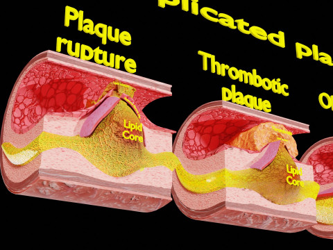 Artery Atherosclerosis plaque and consequences 3D Model