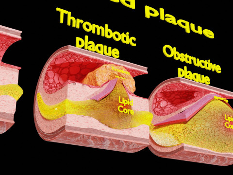 Artery Atherosclerosis plaque and consequences 3D Model