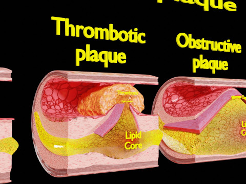 Artery Atherosclerosis plaque and consequences 3D Model
