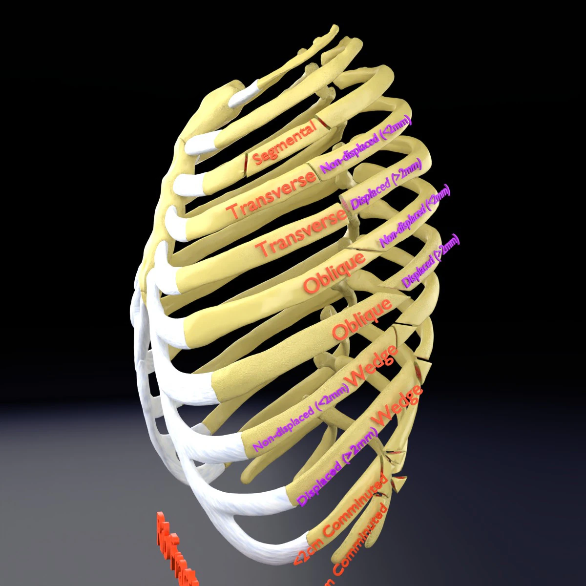 Rib fracture and its types 3D Model .c4d .max .obj .3ds .fbx .stl .blend