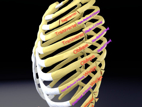 Rib fracture and its types 3D Model