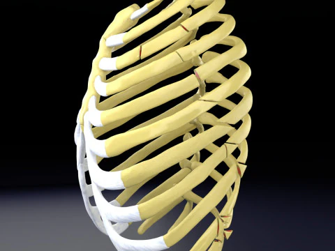 Rib fracture and its types 3D Model