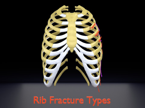 Rib fracture and its types Model 3D