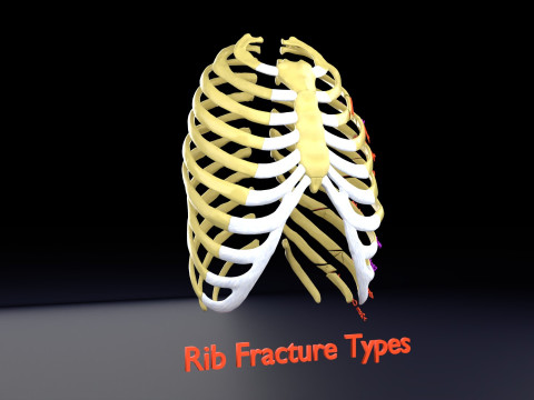 Rib fracture and its types Model 3D
