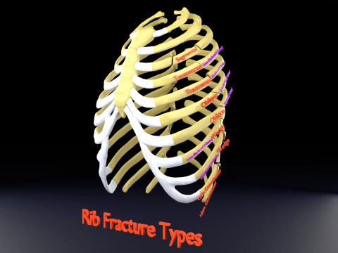 Rib fracture and its types Model 3D